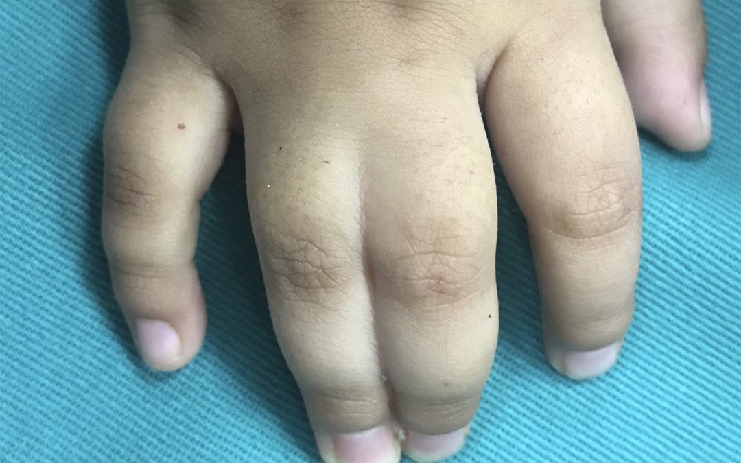 Recaudan fondos para apoyar con gastos médicos a niño con sindactilia