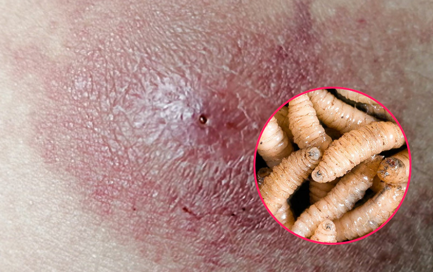 Detectan en Yucatán el segundo caso de gusano barrenador en humanos