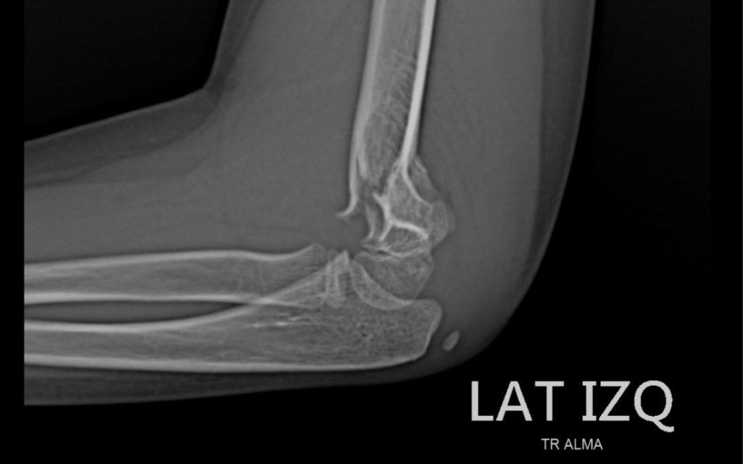 Niña se fractura un brazo en Xtreme Jumping y el lugar no contaba con primeros auxilios ni con botiquín