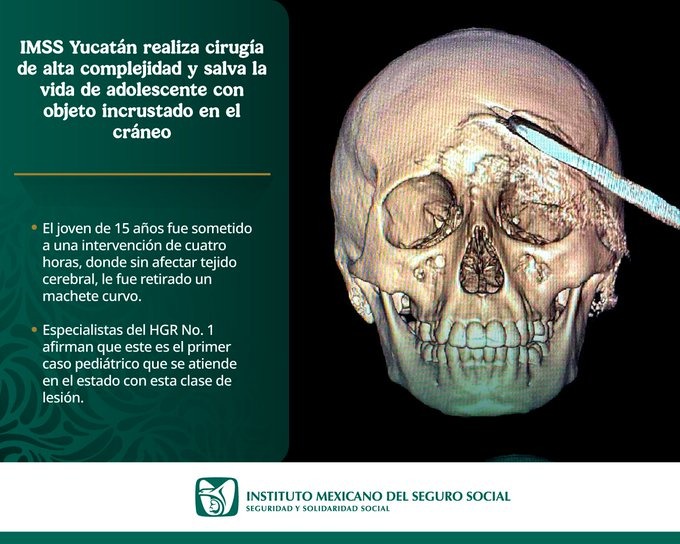 En el IMSS Yucatán salvan a un joven que tenía incrustada una coa en su cráneo
