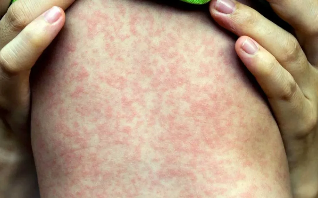 Ante síntomas de sarampión, esto debes hacer